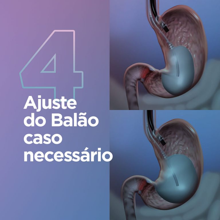Balão Intragástrico: saiba onde você pode colocar o Balão Spatz 3 ...