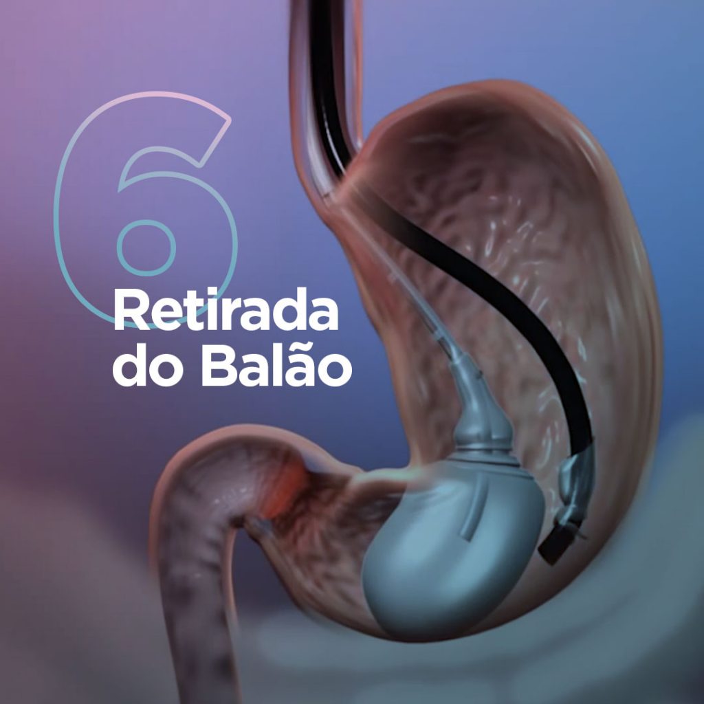 Balão Intragástrico: saiba onde você pode colocar o Balão Spatz 3 ...